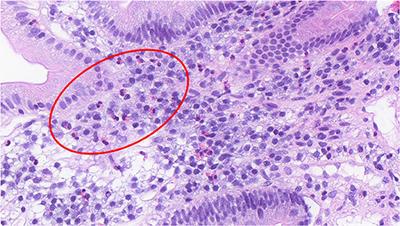 Eosinophils, Hypoxia-Inducible Factors, and Barrier Dysfunction in Functional Dyspepsia